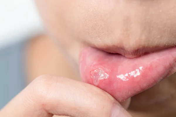 7 Natural Remedies for Mouth Sores