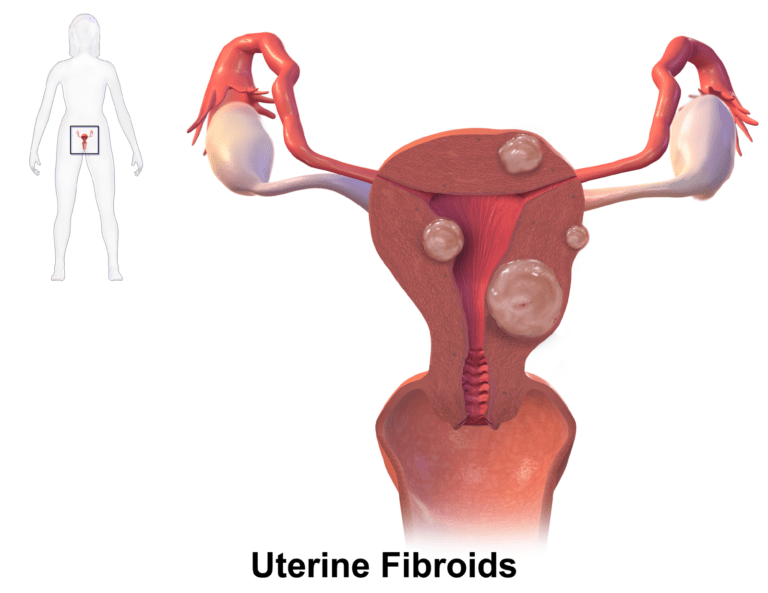 Can you get rid of uterine fibroids without surgery? Natural Cures for Asherman’s Syndrome and Uterine Fibroids | Alive-N-Healthy