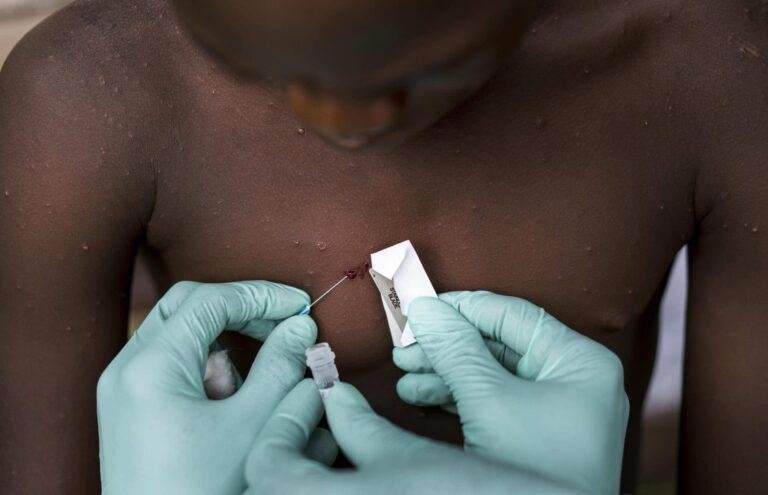 Monkeypox: Doctors concerned about sexual health as cases rise to 80