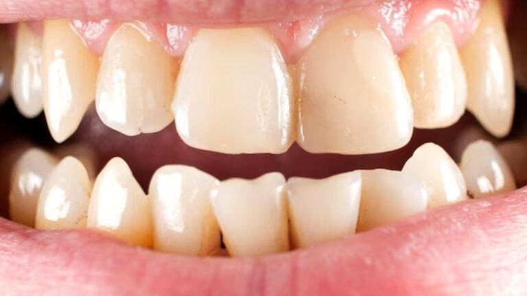 Natural Remedies For Removing Tartar Buildup
