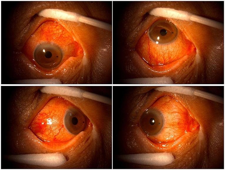 20,000% Increase in Retinal Eye Damage Following COVID-19 Vaccination