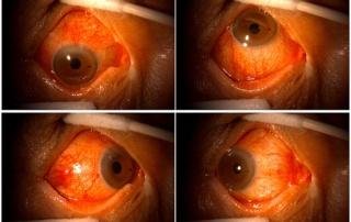 https://healthimpactnews.com/wp-content/uploads/sites/2/2023/05/Ocular-injuries-covid-vaccines-320x202.jpg