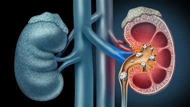 Antibiotics Identified As Risk Factors For Kidney Stones | Holistic Health Online