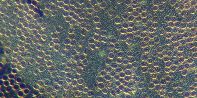 Rubbery Clot Formation Shown In Living C19 Unvaccinated - Hydrogel Replacing Blood | Holistic Health Online