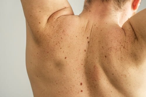 Best Chest Acne Treatment (5 Natural Remedies You Can Do at Home)